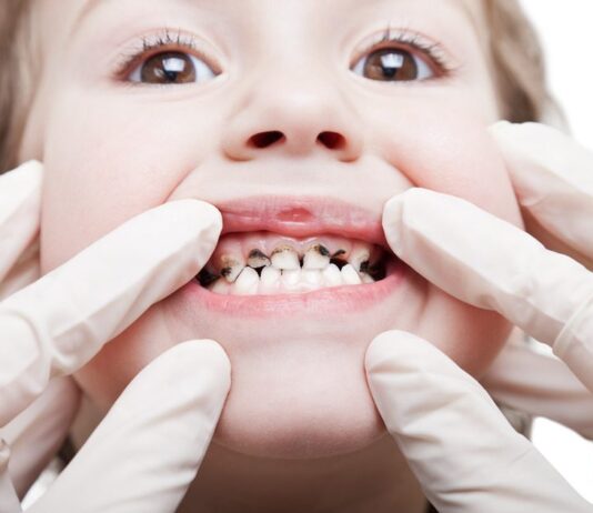 หนอนในช่องปาก กับ 4 วิธีดูแล และป้องกันอย่างไรบ้าง