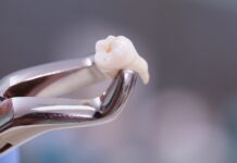 ถอนฟันกี่วันแผลหาย ถอนฟันกี่วันแผลหาย