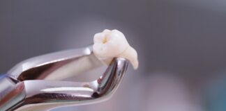 ถอนฟันกี่วันแผลหาย ถอนฟันกี่วันแผลหาย