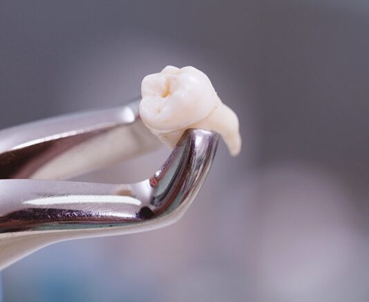 ถอนฟันกี่วันแผลหาย ถอนฟันกี่วันแผลหาย