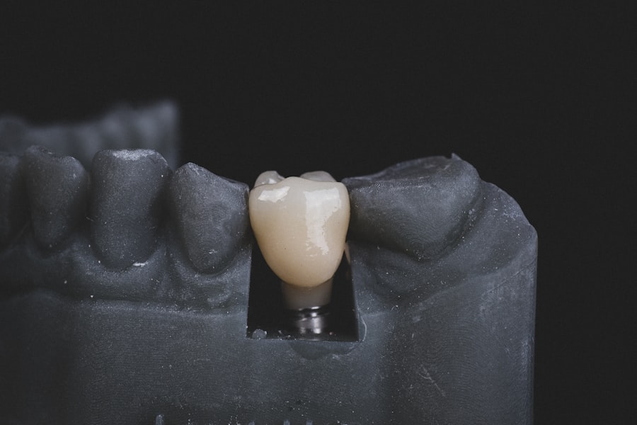 Photo dental implants